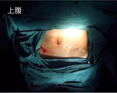 宮、腹腔鏡聯(lián)合治療不孕優(yōu)勢(shì)